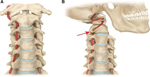 Rotational vertebral artery syndrome